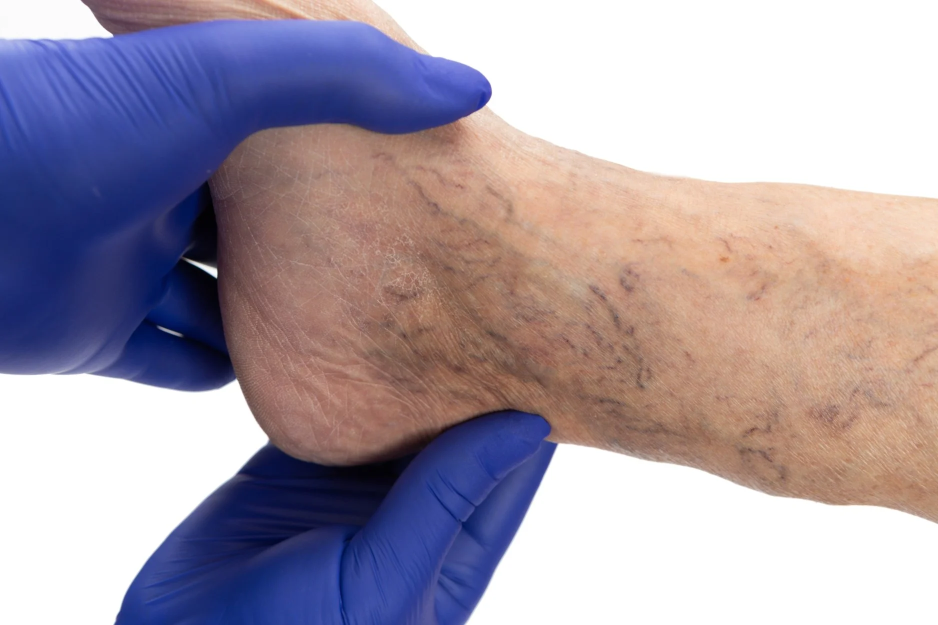 Ambulatory Phlebectomy services Texas Vein and Vascular in Corpus Christi TX