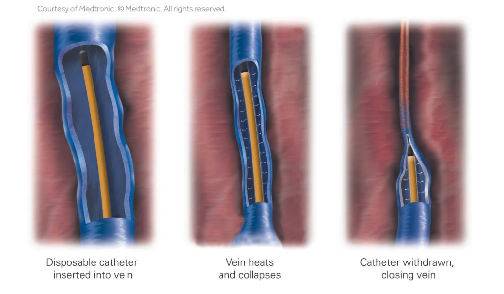 ClosureFast-Procedure-carousal-Texas-Vein-and-Vascular-in-Corpus-Christi-TX