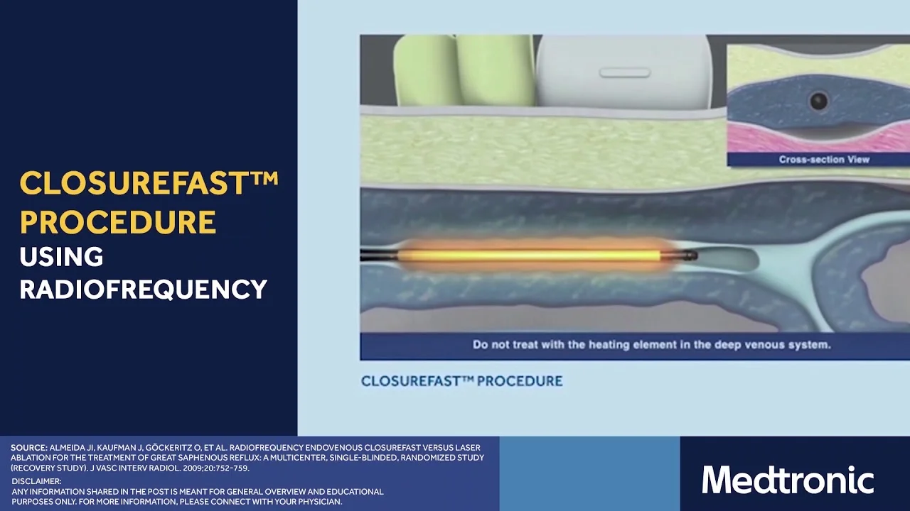 ClosureFastProcedure-carousal-Texas-Vein-and-Vascular-in-Corpus-Christi-TX