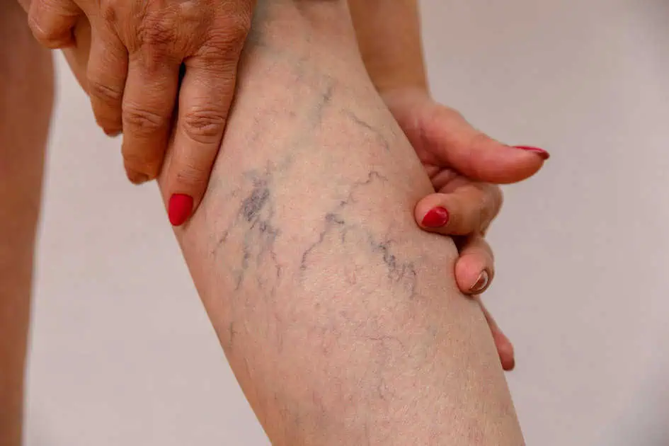 Varicose Vein by Texas Vein and Vascular in 5242 Holly Rd Corpus Christi, TX 78411