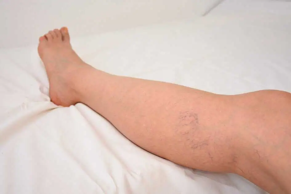 Endovenous Laser and Radio Frequency in Corpus Christi, TX by Texas Vein and Vascular