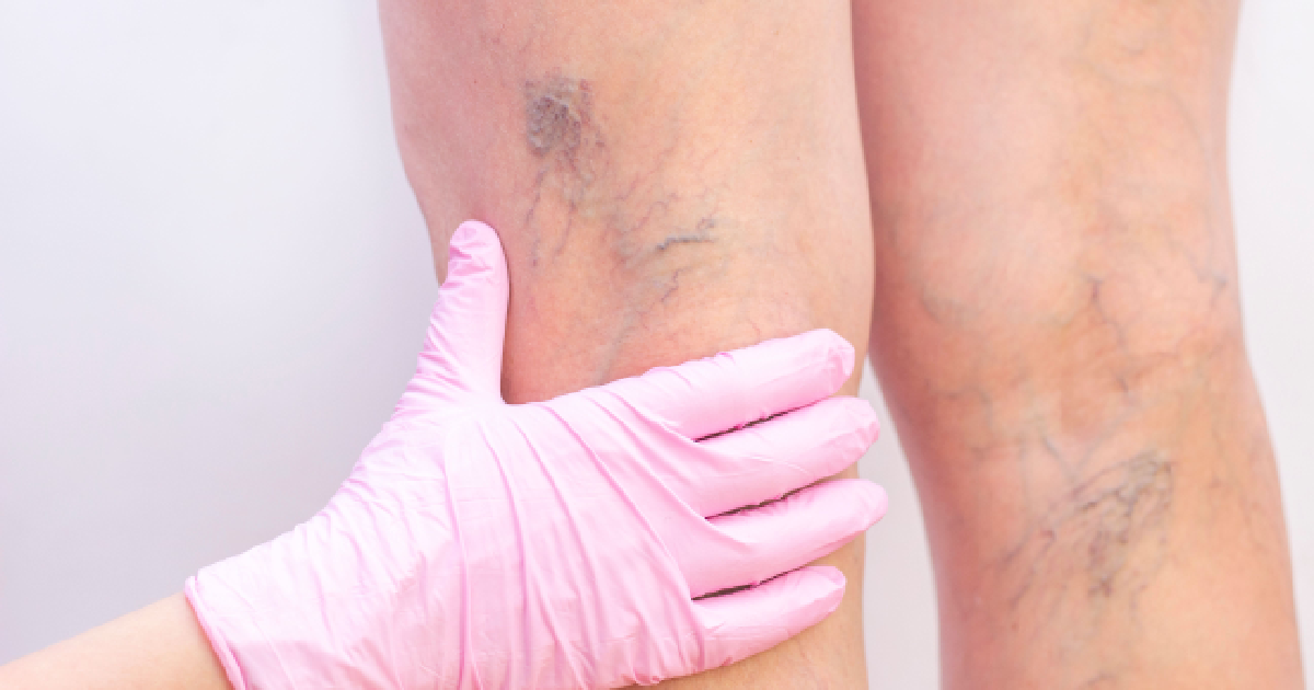 A patient showing leg with vein before doing Varithena treatment in Corpus Christi, TX