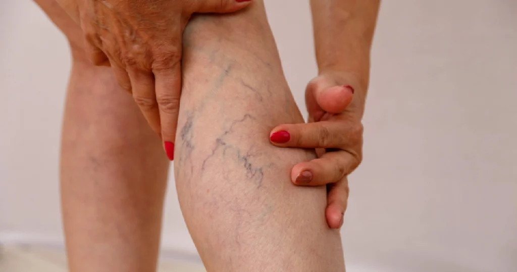 Close up of a woman holding her leg with visible varicose veins representing the need for the ClosureFast Procedure