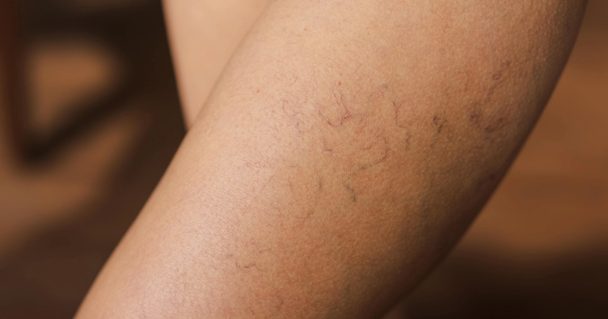 Veinwave Treatment for spider veins on leg in Corpus Christi, TX
