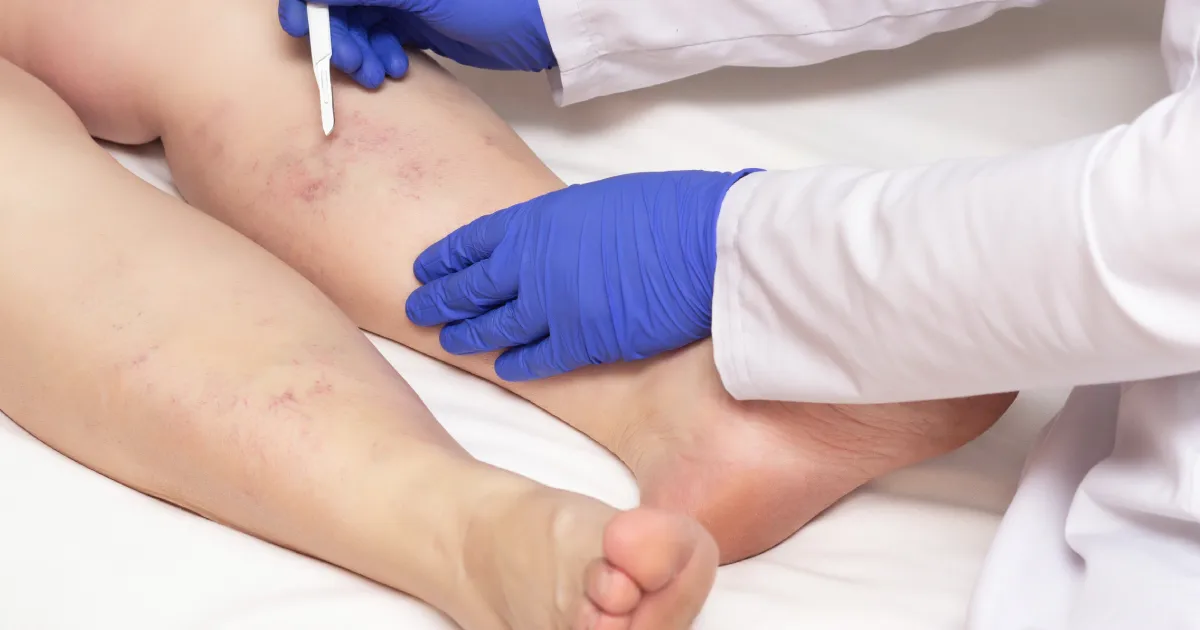 A person’s leg showing visible varicose veins represents Varithena vein treatment in Corpus Christi, TX, for improving leg health and comfort.