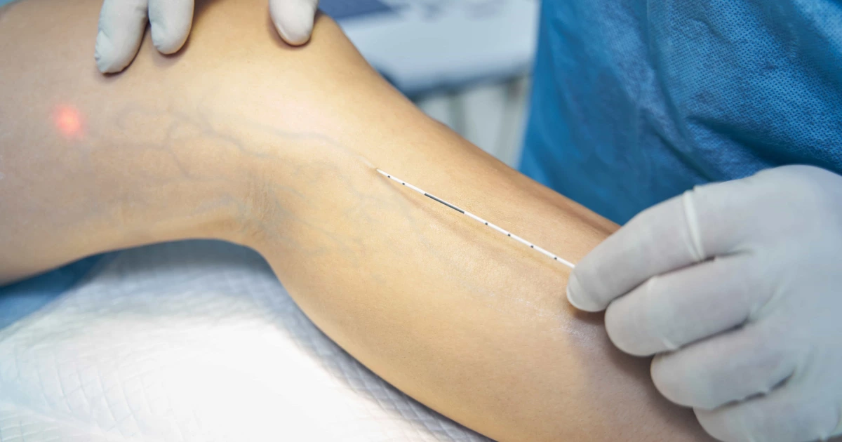 Endovenous Laser and Radio Frequency treatment for varicose veins in Corpus Christi, TX, showing minimally invasive vein therapy on the leg