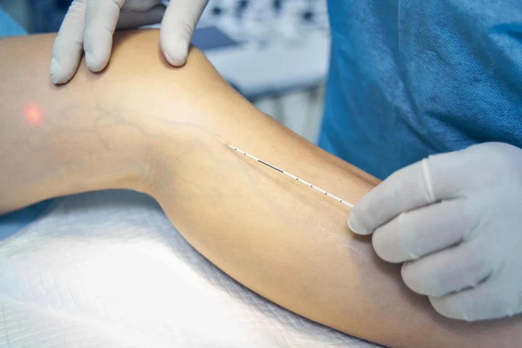 Professional providing endovenous laser therapy for painful veins